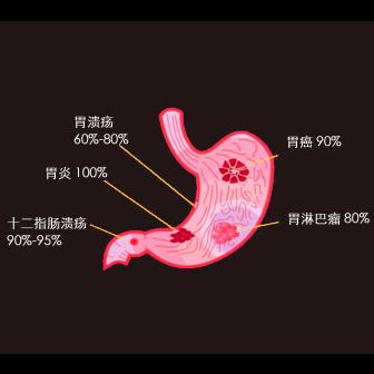 JXWY-急性胃炎